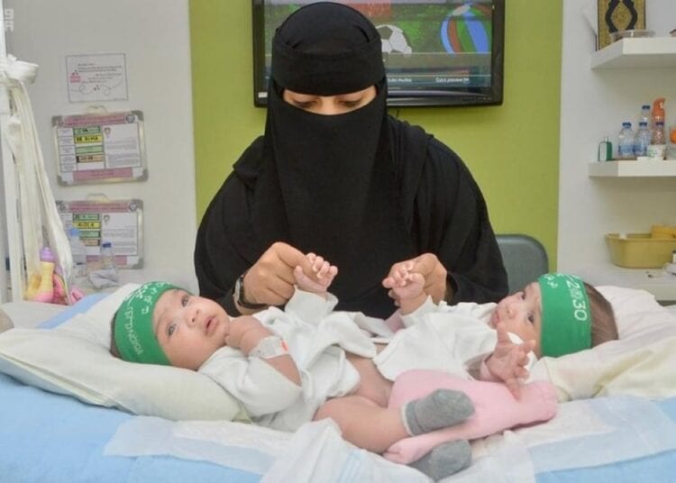اليوم العالمي “للتوائم الملتصقة”.. العالم يحتفل بمبادرة المملكة