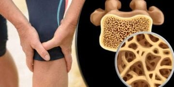 5 مؤشرات لهشاشة العظام.. تعرف عليها