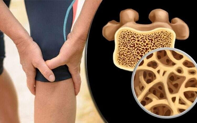 5 مؤشرات لهشاشة العظام.. تعرف عليها
