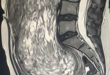 مدينة الملك عبدالله الطبية تنجح في استئصال ورم بحجم جنين من ثلاثينية سعودية