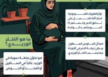5 إرشادات لتجنب الإصابة بالتخثر الوريدي