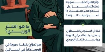 5 إرشادات لتجنب الإصابة بالتخثر الوريدي