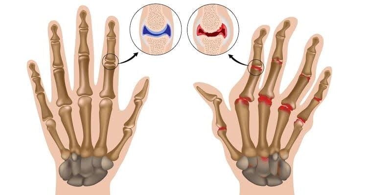مؤتمر طب المستجدات في علاج أمراض الروماتيزم ينطلق غدًا بجدة