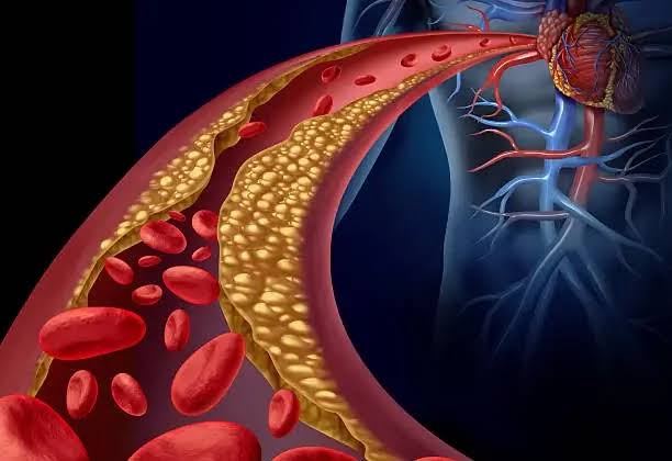 أستاذ طب باطني يحذر: تصلب الشرايين سبب رئيسي لجلطات المخ ويدعو للوقاية المبكرة