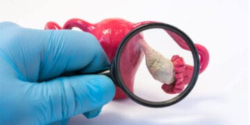التشخيص المبكر يقلل خطورته.. أطباء يحذّرون من الأعراض الصامتة لسرطان المبيض