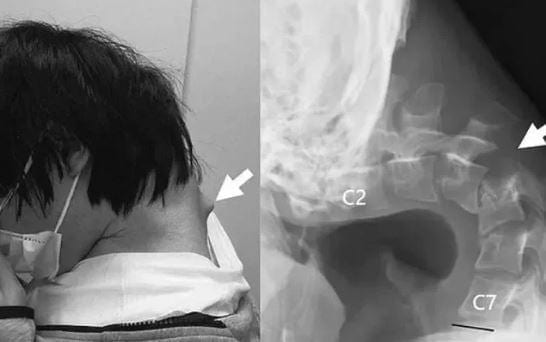شاب يفقد القدرة على رفع رأسه بسبب الهاتف.. قصة تحذيرية من متلازمة نادرة