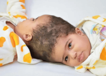 فصل توأم بعد جراحة معقدة
