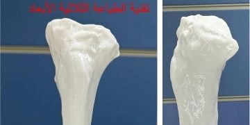 بأيدٍ سعودية وبتقنية الطباعة ثلاثية الأبعاد..  نجاح باهر لعملية تصحيح انحراف شديد في الركبة بمستشفى الملك فهد الجامعي