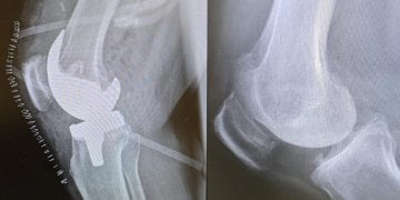 مستشفى الدكتور سليمان الحبيب ينجح في إجراء عملية دقيقة لاستبدال مفصلي الركبة لسيدة سبعينية