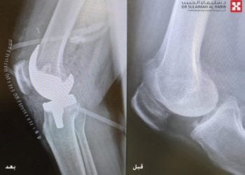 مستشفى الدكتور سليمان الحبيب ينجح في إجراء عملية دقيقة لاستبدال مفصلي الركبة لسيدة سبعينية