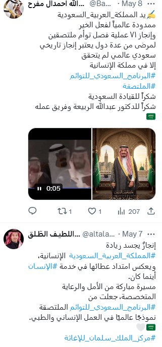 فصل التوأم الملتصق التنزاني.