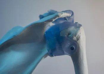 فقدان الطول.. 5 مؤشرات لهشاشة العظام