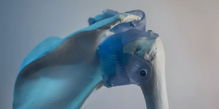 فقدان الطول.. 5 مؤشرات لهشاشة العظام