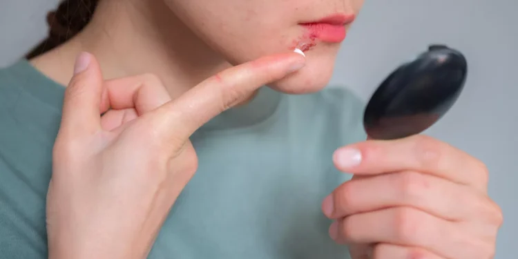 دراسة تكشف عن تأثير فيروس الهربس البسيط على الدماغ