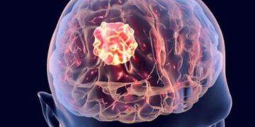 ابتكار تقنية جديدة يمكن ان تعالج سرطان المخ