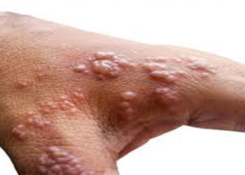 كندا ترصد أول إصابة بالسلالة الفرعية 1 من جدري القردة