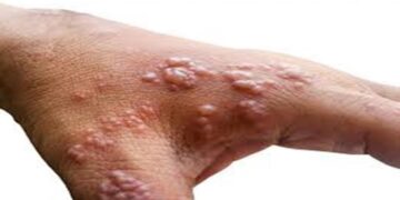 كندا ترصد أول إصابة بالسلالة الفرعية 1 من جدري القردة