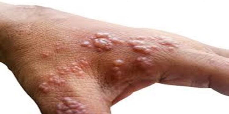 كندا ترصد أول إصابة بالسلالة الفرعية 1 من جدري القردة