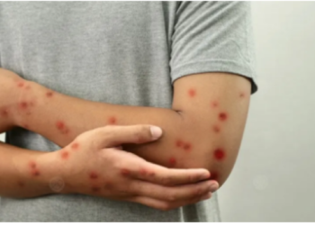 الولايات المتحدة تسجل أول إصابة بسلالة فرعية من جدري القردة