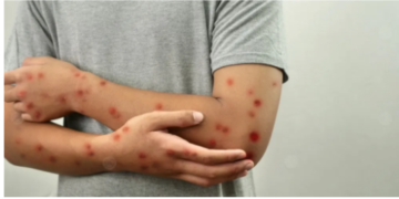 الولايات المتحدة تسجل أول إصابة بسلالة فرعية من جدري القردة