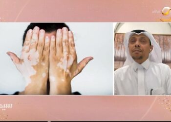 مختص: إصابة الطفل بتغيير في تصبغات الجلد يستوجب المتابعة بشكل سريع