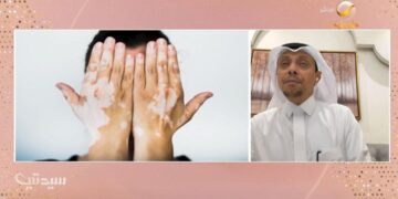 مختص: إصابة الطفل بتغيير في تصبغات الجلد يستوجب المتابعة بشكل سريع