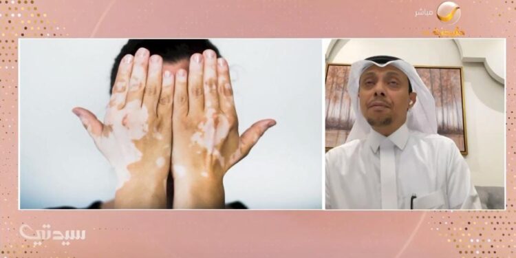 مختص: إصابة الطفل بتغيير في تصبغات الجلد يستوجب المتابعة بشكل سريع