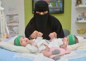 اليوم العالمي “للتوائم الملتصقة”.. العالم يحتفل بمبادرة المملكة