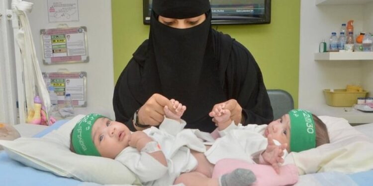 اليوم العالمي “للتوائم الملتصقة”.. العالم يحتفل بمبادرة المملكة