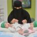 اليوم العالمي “للتوائم الملتصقة”.. العالم يحتفل بمبادرة المملكة