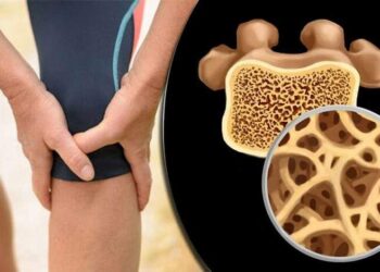 5 مؤشرات لهشاشة العظام.. تعرف عليها