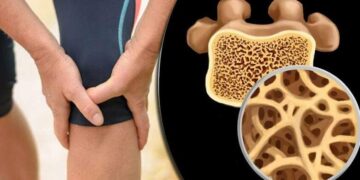 5 مؤشرات لهشاشة العظام.. تعرف عليها