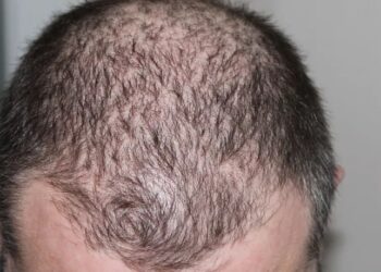 نظام شهير لخسارة الوزن يزيد من فرص الإصابة بالصلع