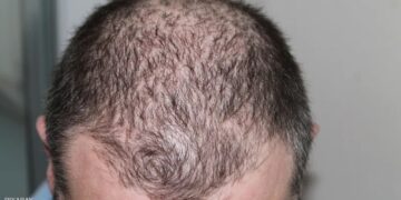 نظام شهير لخسارة الوزن يزيد من فرص الإصابة بالصلع