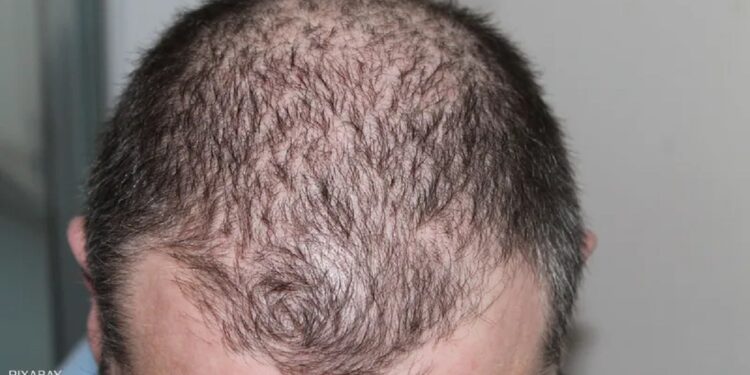 نظام شهير لخسارة الوزن يزيد من فرص الإصابة بالصلع