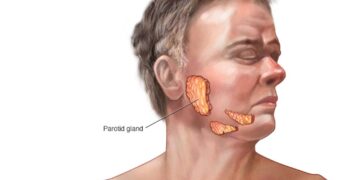 ينتقل من الرذاذ.. تعرف على أعراض “النكاف” ومضاعفاته وطرق الوقاية