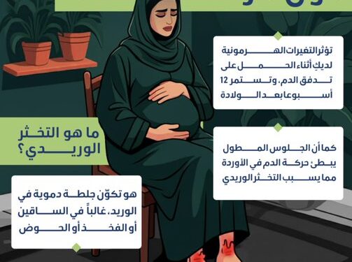 5 إرشادات لتجنب الإصابة بالتخثر الوريدي