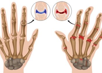مؤتمر طب المستجدات في علاج أمراض الروماتيزم ينطلق غدًا بجدة