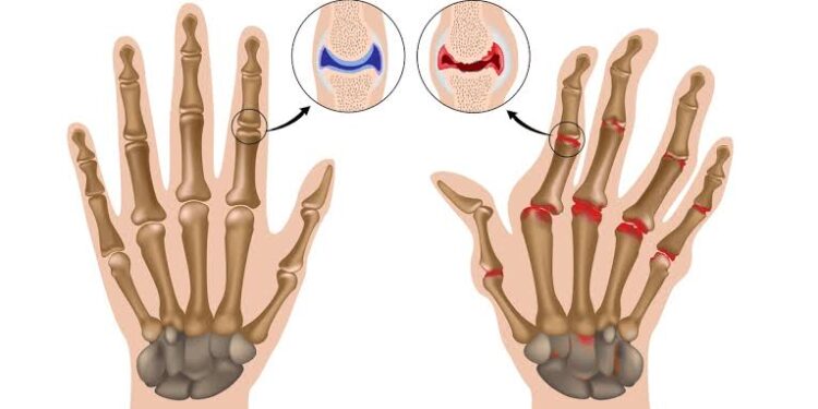 مؤتمر طب المستجدات في علاج أمراض الروماتيزم ينطلق غدًا بجدة