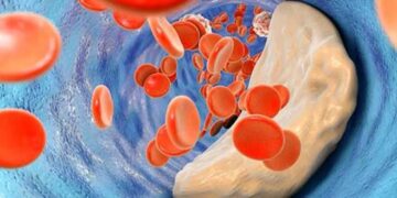 استشاري: مستوى الكوليسترول الضار يجب أن يكون أقل من 55 لدى مرضى جلطات القلب