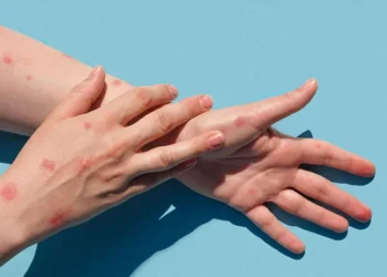 أوغندا تتجاوز حاجز الألف حالة إصابة بجدري القردة