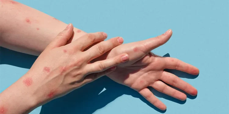 أوغندا تتجاوز حاجز الألف حالة إصابة بجدري القردة