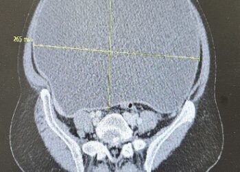 استئصال ورم سرطاني ضخم أدى إلى إزاحة أعضاء البطن لمريضة سبعينية في القصيم