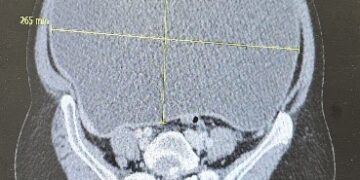 استئصال ورم سرطاني ضخم أدى إلى إزاحة أعضاء البطن لمريضة سبعينية في القصيم
