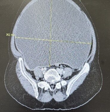 استئصال ورم سرطاني ضخم أدى إلى إزاحة أعضاء البطن لمريضة سبعينية في القصيم