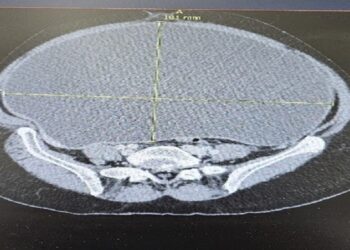 استئصال ورم سرطاني ضخم أزاح أعضاء البطن لمريضة سبعينية في القصيم