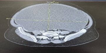 استئصال ورم سرطاني ضخم أزاح أعضاء البطن لمريضة سبعينية في القصيم