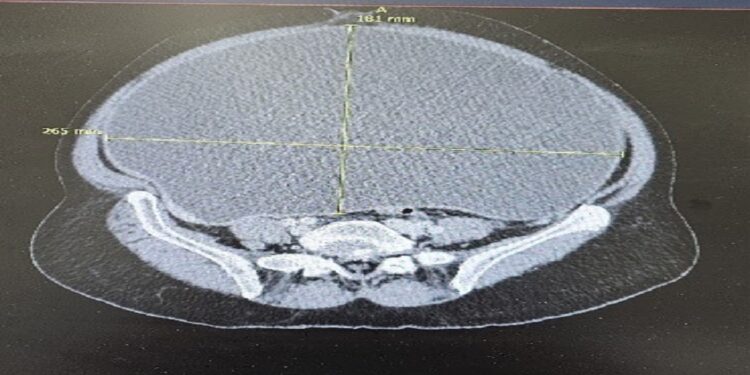 استئصال ورم سرطاني ضخم أزاح أعضاء البطن لمريضة سبعينية في القصيم