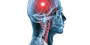 استشاري: 20% من جلطات الدماغ لدى كبار السن سببها رجفان القلب الأذيني