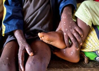 تسجيل 1267 حالة وفاة بجدري القردة في الكونغو الديمقراطية